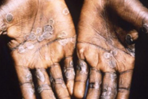 APA ITU MONKEYPOX (CACAR MONYET)?
