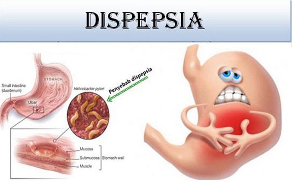 KENALI PENYAKIT DISPEPSIA